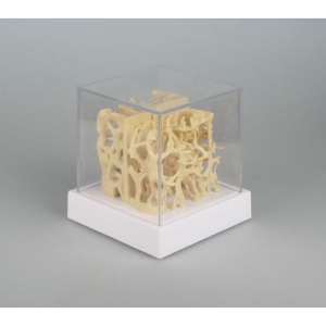 Osteoporosis Bone Structure Comparison Model